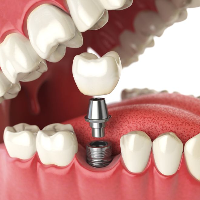 Implant-Supported Dentures